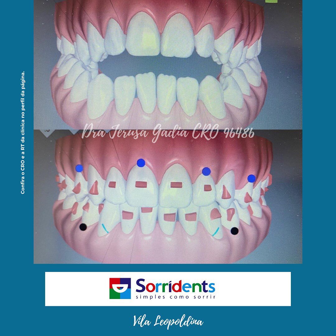Resultado de tratamento odontológico antes e depois - Sorridents Vila dos Remédios