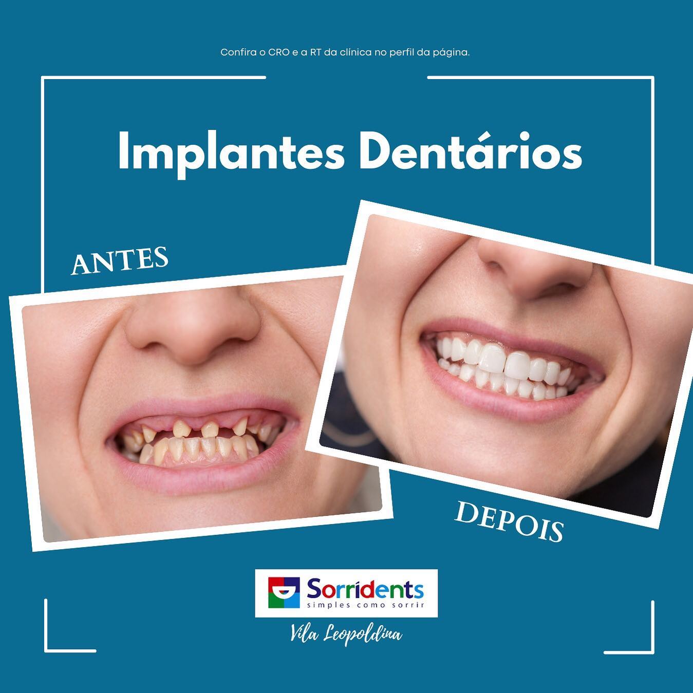 Transformação odontológica antes e depois - Sorridents Vila dos Remédios