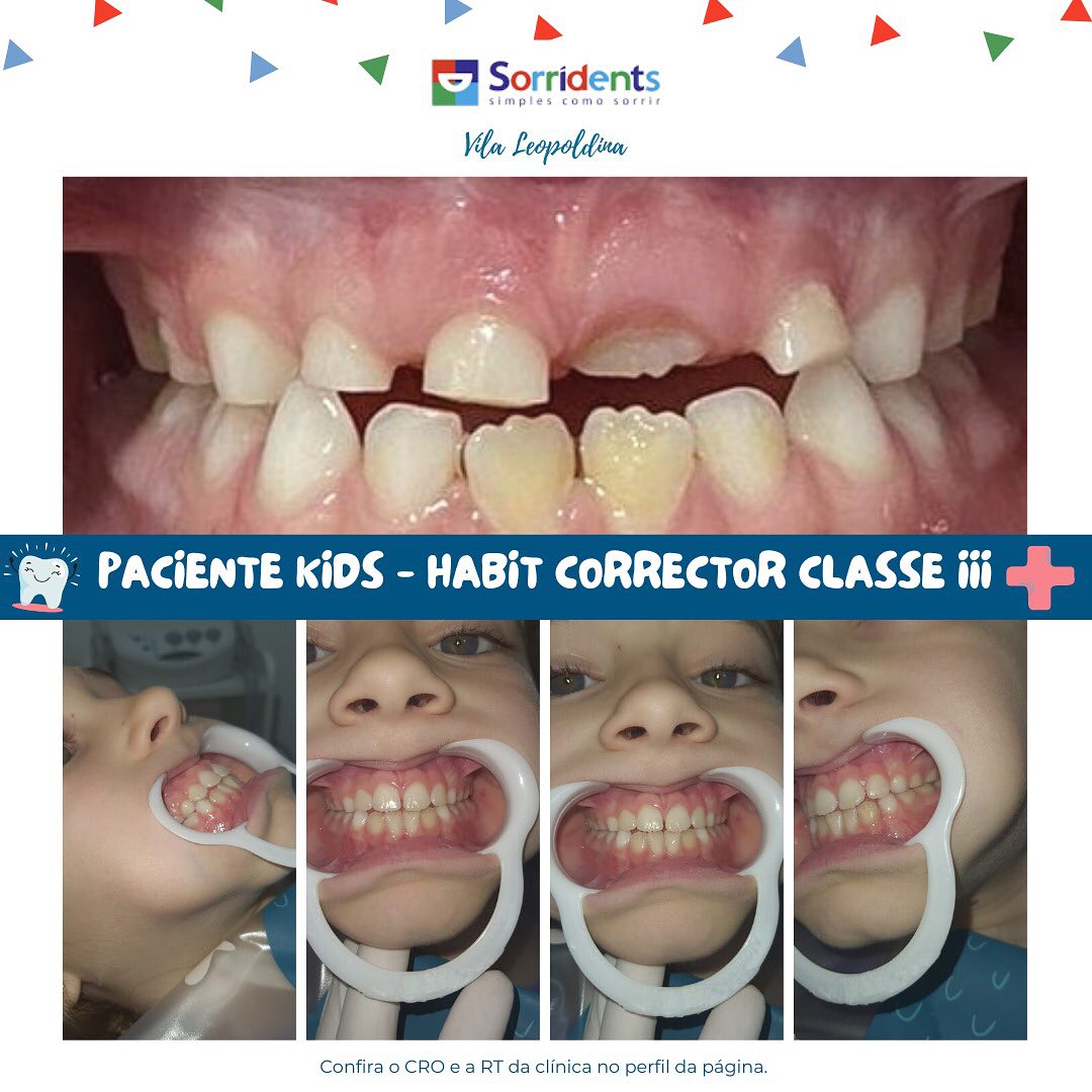 Resultado de tratamento odontológico antes e depois na clínica Sorridents