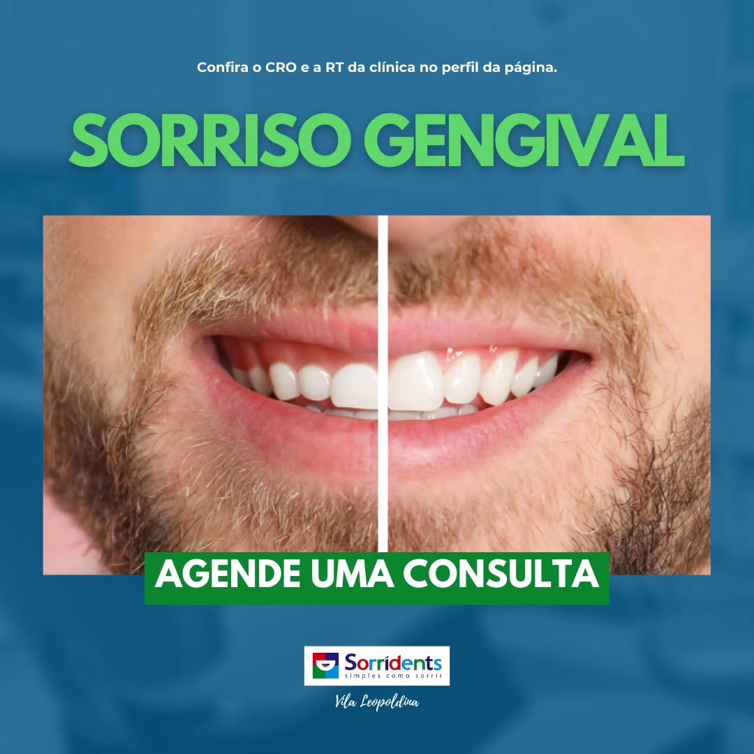 Transformação do sorriso antes e depois - Sorridents Vila dos Remédios