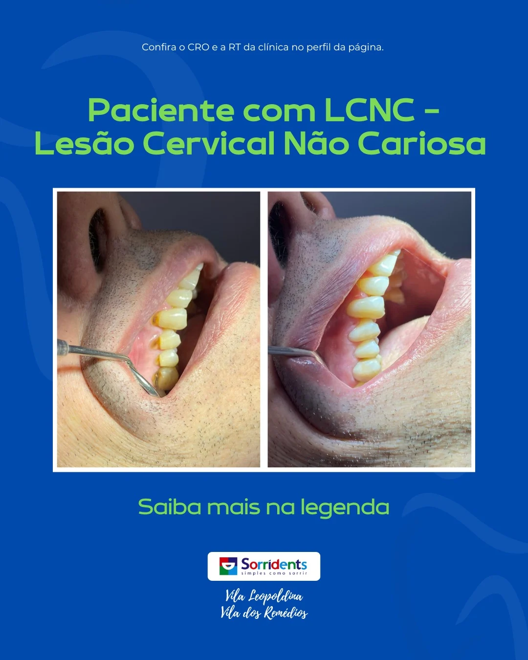 Resultado de tratamento odontológico antes e depois na Sorridents Vila dos Remédios