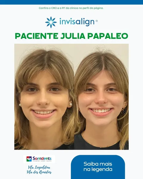 Transformação dental antes e depois - Sorridents clínica odontológica Vila dos Remédios